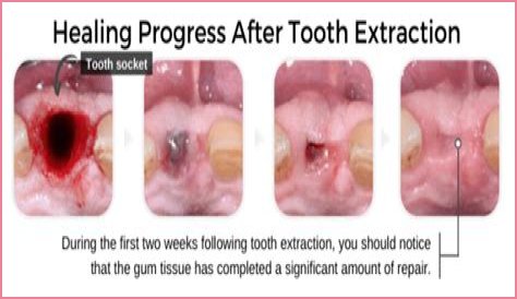 How long does it take for a molar extraction to heal?